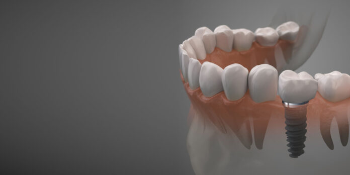 Dental Implants for Low-Income Individuals